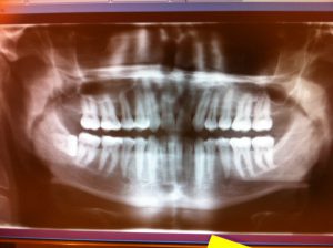 Impacted Wisdom Tooth X-Ray